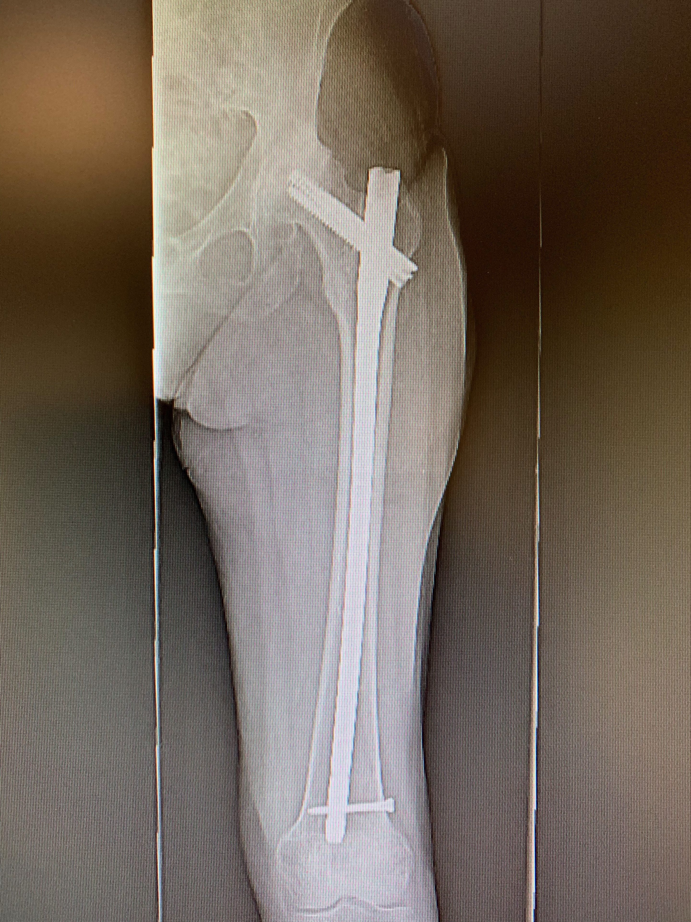 Complex hip replacement - Hip replacement with prior hardware in position in a 71 year old female