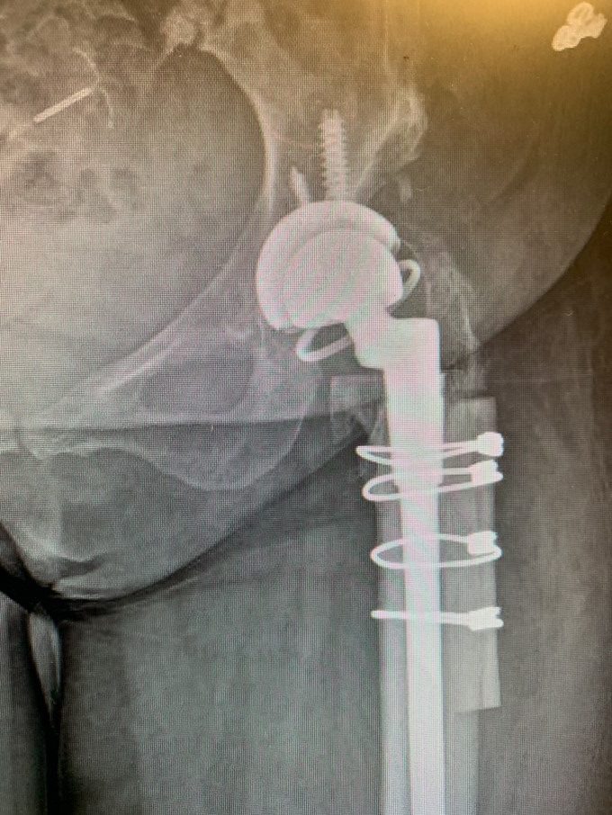 Complex hip replacement for hip Dysplasia