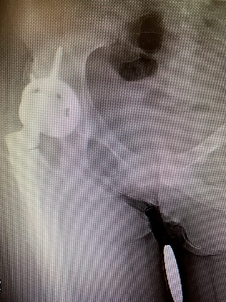 Hip dislocation treatment – Acetabular component exchange in total hip replacementa