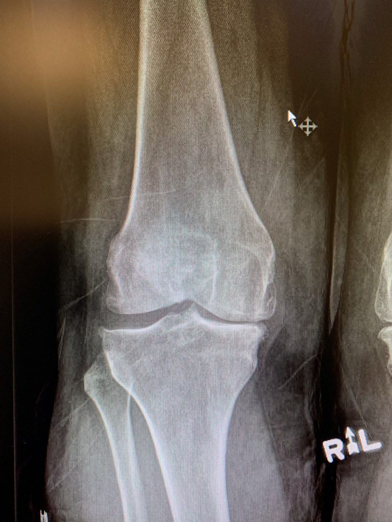 Primary Knee replacement with custom instrumentation in a 63 year old malea