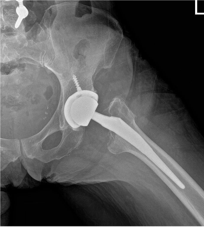 Post operative view xray of the hip