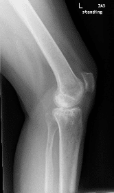 Xray of a left knee