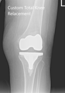 Radiografía postoperatoria que muestra AP y vistas laterales de la articulación de la rodilla derecha e izquierda