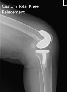 Radiografía postoperatoria que muestra AP y vistas laterales de la articulación derecha e izquierda de la rodilla - img 2