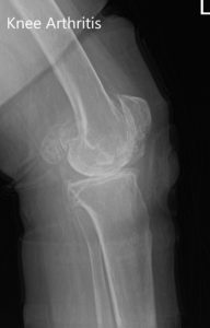 Radiografía preoperatoria de la rodilla izquierda que muestra AP y vistas laterales - img 2