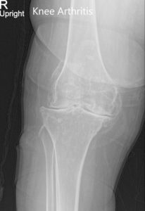 Radiografía preoperatoria de la rodilla derecha que muestra AP y vistas laterales