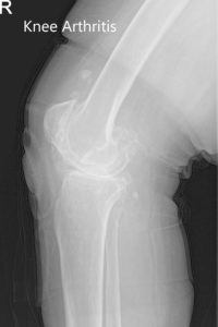 Radiografía preoperatoria de la rodilla derecha que muestra AP y vistas laterales - img 2