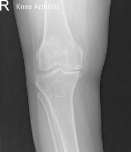 Radiografía preoperatoria de la rodilla derecha que muestra AP y vistas laterales