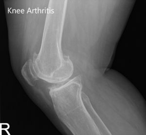 Preoperative X-ray of the right knee showing AP and lateral views - img 2