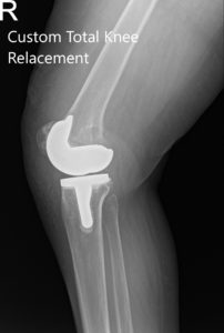 Radiografía postoperatoria de la rodilla derecha que muestra vistas AP y oblicuas - img 2