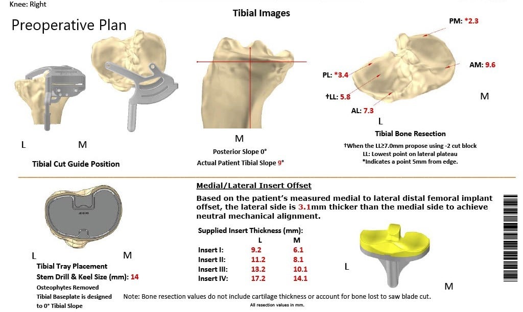 Complete Orthopedics patient specific surgical plan for a Customized Total Knee Replacement in a 58-year-old female with Arthritis