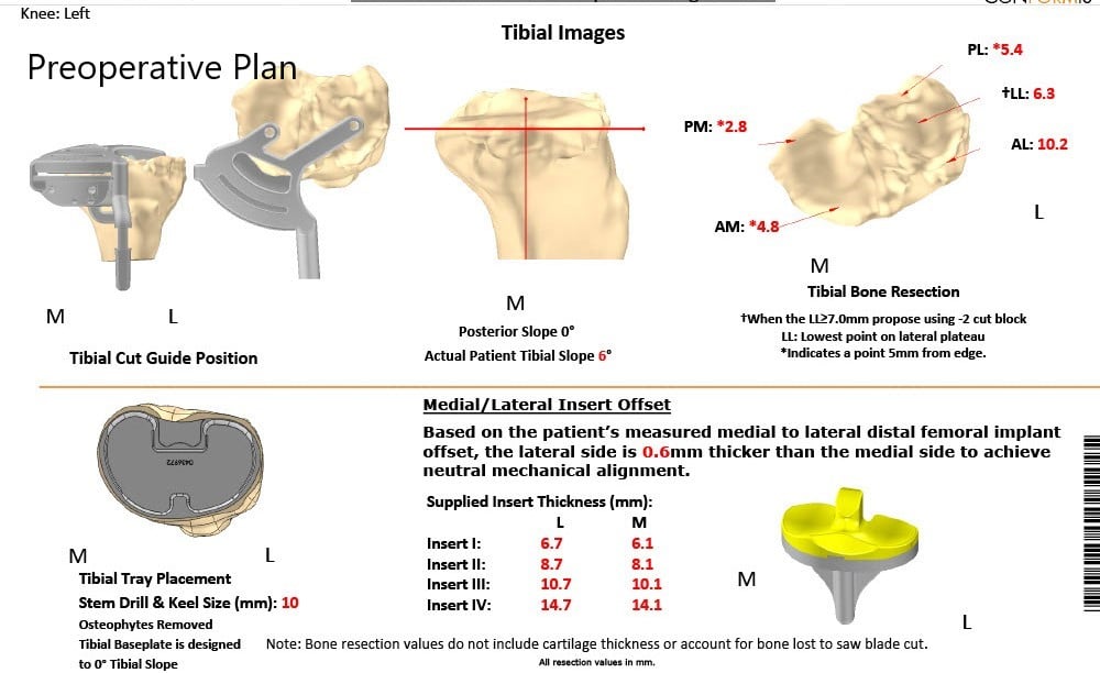 Complete Orthopedics patient specific surgical plan for Customized Total Knee Replacement in a 59-year-old male