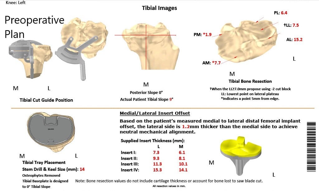 Complete Orthopedics patient specific surgical plan for a ustom Left Total Knee Replacement in a 66-year-old male