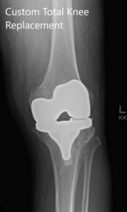 Postoperative X-ray showing AP and lateral images of the left knee