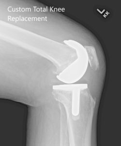 Postoperative X-ray showing AP and lateral images of the left knee - img 2