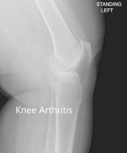 Vista anteroposterior y lateral de la rodilla izquierda - img 2