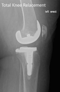 Radiografía postoperatoria de la izquierda que muestra la vista anteroposterior y lateral con prótesis total de rodilla en posición