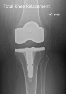 Radiografía postoperatoria de la izquierda que muestra la vista anteroposterior y lateral con prótesis total de rodilla en posición - img 2