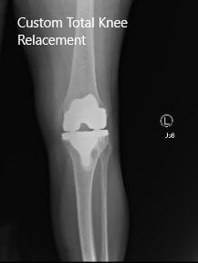 Post-Operative X-ray images showing AP and Lateral view