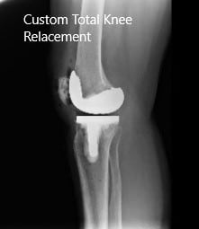 Post-Operative X-ray images showing AP and Lateral view - img 2