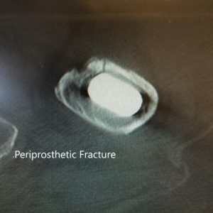 La tomografía computarizada y la radiografía de la cadera izquierda revelaron una fractura periprotésica no desplazada del fémur proximal anteromedialmente con hundimiento del vástago