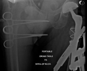 Imágenes de rayos X intraoperatorias y postoperatorias que muestran cables utilizados para la fijación de fracturas y vástago femoral largo revisado 