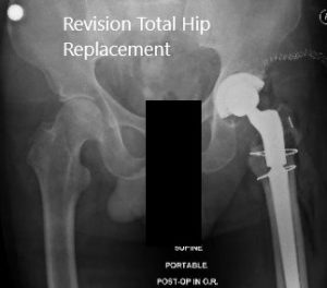 Imágenes de rayos X intraoperatorias y postoperatorias que muestran cables utilizados para la fijación de fracturas y vástago femoral largo revisado - img 2