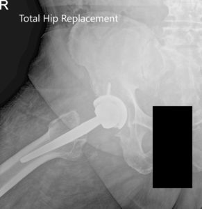 Postoperative X-ray showing AP and frog-leg lateral views of the right hip - img 2