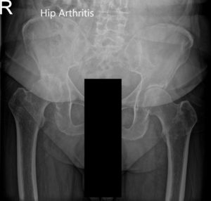 Preoperative X-ray of Pelvis AP view and frog legged lateral view of the right hip