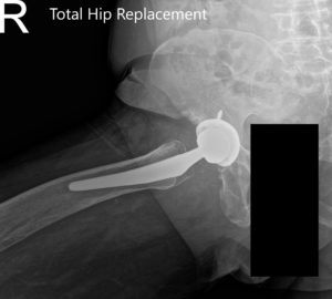 Postoperative X-ray showing the AP view of the pelvis and the frog-legged lateral view of the right hip.