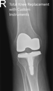 Radiografía ostoperatoria de la rodilla derecha en vistas anteroposterior y lateral