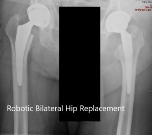 Postoperative X-ray of the patient’s pelvis with both hips