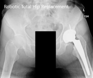 Radiografía postoperatoria de la pelvis con ambas articulaciones de la cadera en la vista AP