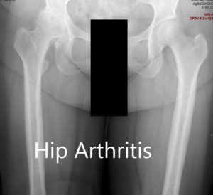 Preoperative X-ray showing the AP view of the pelvis with both hip joints