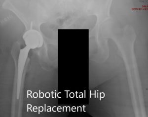 Postoperative images showing the AP and lateral images.