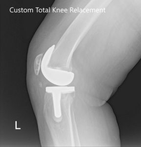 Radiografía postoperatoria de la rodilla izquierda que muestra AP y vista lateral