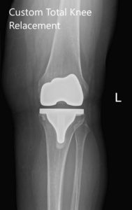 Radiografía postoperatoria de la rodilla izquierda que muestra PA y vista lateral - img 2