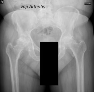 Vista AP de la radiografía de la pelvis que muestra ambas articulaciones de la cadera con vistas laterales de la pata de rana de las articulaciones de la cadera derecha e izquierda que sugieren osteoartritis bilateral severa de las articulaciones de la cadera