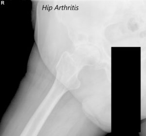 Vista AP de la radiografía de la pelvis que muestra ambas articulaciones de la cadera con vistas laterales de la pata de rana de las articulaciones de la cadera derecha e izquierda que sugieren osteoartritis bilateral severa de las articulaciones de la cadera - img 2