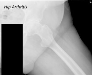 Vista AP de la radiografía de la pelvis que muestra ambas articulaciones de la cadera con vistas laterales de la pata de rana de las articulaciones de la cadera derecha e izquierda que sugieren osteoartritis bilateral severa de las articulaciones de la cadera - img 3