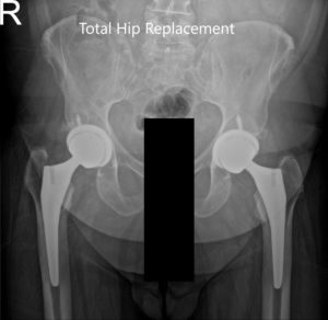 Vista AP postoperatoria de la radiografía de la pelvis que muestra ambas articulaciones de la cadera con vistas laterales de la pata de rana de las articulaciones de la cadera derecha e izquierda