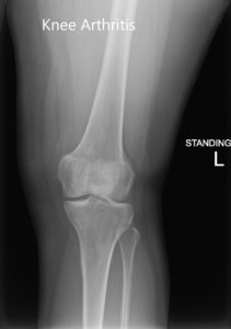 Preoperative X-ray of the left knee showing AP and lateral images 