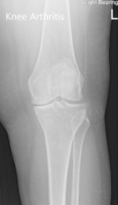 Radiografía preoperatoria de la rodilla izquierda que muestra AP y vistas laterales