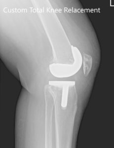 Tres meses de radiografía postoperatoria de la rodilla izquierda que muestra AP e imágenes laterales