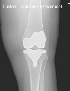 Tres meses de radiografía postoperatoria de la rodilla izquierda que muestra imágenes de AP y laterales - img 2