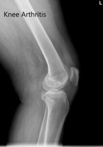 Pre-operative X-ray of the left knee showing AP and lateral views