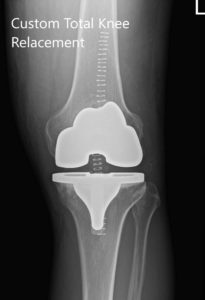 Radiografía preoperatoria de la rodilla izquierda que muestra AP y vistas laterales