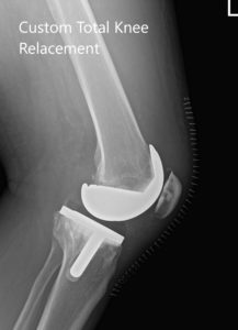 Radiografía preoperatoria de la rodilla izquierda que muestra AP y vistas laterales - img 2