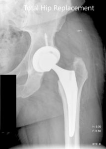 Postoperative X-ray images showing AP view and frog legged lateral view