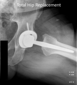 Postoperative X-ray images showing AP view and frog legged lateral view - img 2